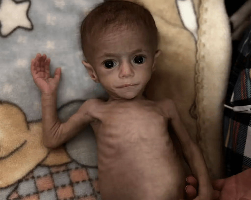 Siwar Ashour tem 5 meses e pesa apenas 2,9kg